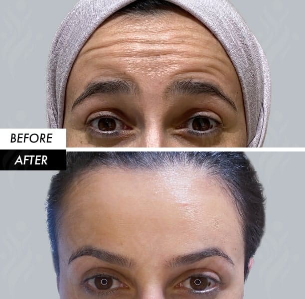 Forehead Botox before and after in Dubai by Dr Azra Vaziri — smoothed forehead lines