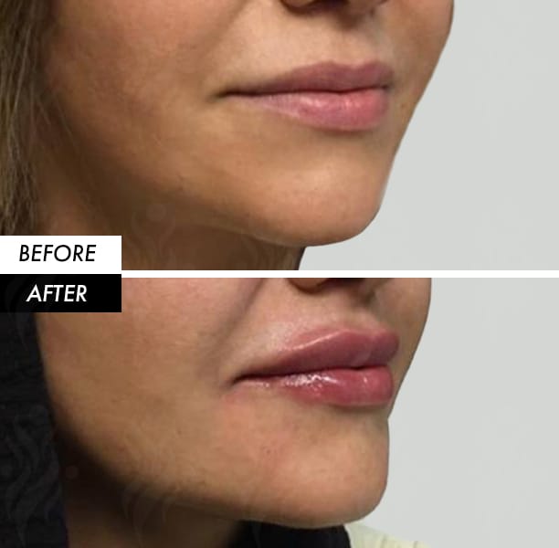 Lip filler before and after in Dubai by Dr Azra Vaziri — defined, natural volume