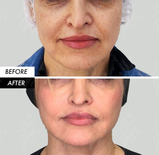 Thread lift before and after in Dubai by Dr Azra Vaziri — lifted jawline and cheeks