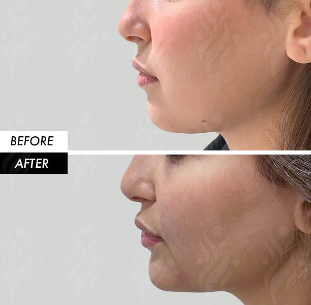 Chin filler before and after in Dubai by Dr Azra Vaziri — balanced profile