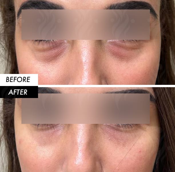 Under-eye filler before and after in Dubai by Dr Azra Vaziri — hollows and shadows softened