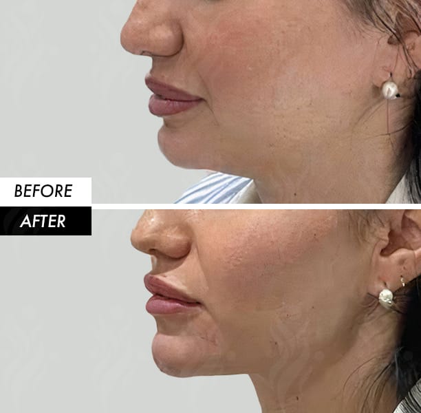 Masseter Botox before and after in Dubai by Dr Azra Vaziri — slimmer lower face